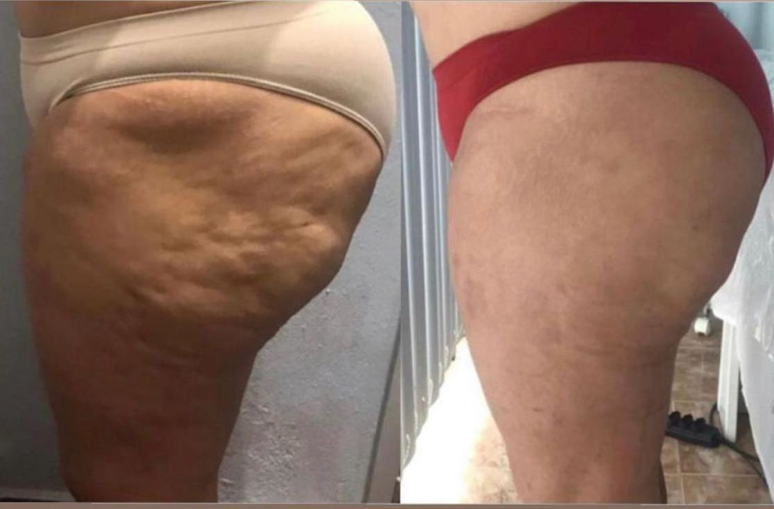 Protocolo Atualizado de Lipedema